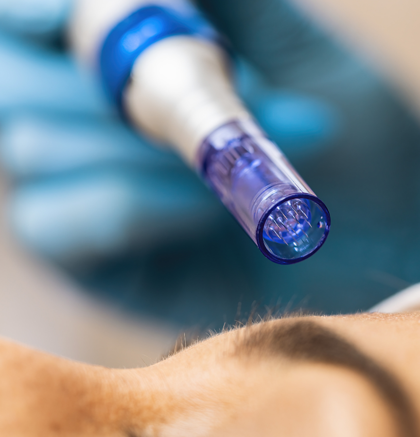 caneta para microagulhamento, procedimento que auxilia na produção de colágeno e rejuvenescimento da pele